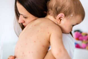 Հայաստանում կարմրուկի լաբորատոր հաստատված դեպքերի թիվը հասել է 500-իpx