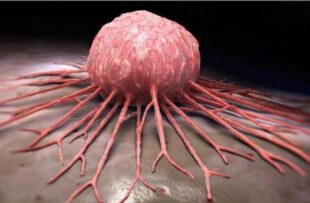 Քաղցկեղի ամենատարածված տեսակները Հայաստանումpx